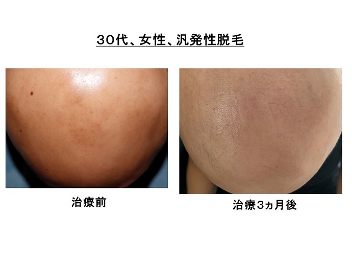 円形脱毛症　病院
